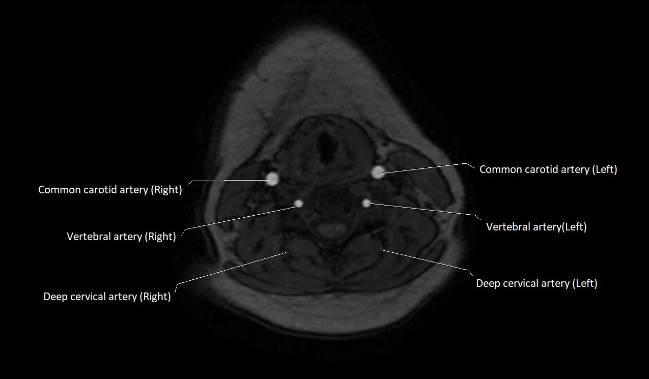 Carotid artery anatomy axial 3T image 38.jpg